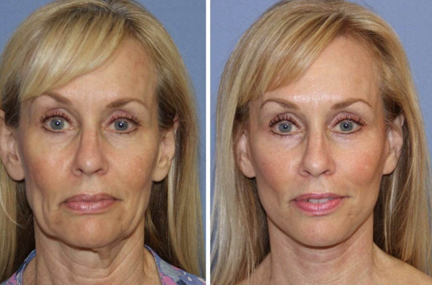 Vivace Microneedling